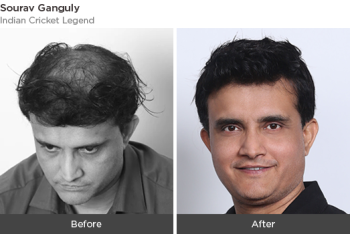 Redefining Hair Transplant in Dubai Experience | AHS UAE