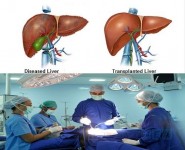 Who Requires a Liver Transplant?