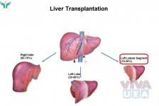 Liver Transplant Cost and Treatment In India