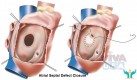 Atrial Septal Defect (ASD) Closure Treatment In India