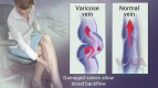 VenoCare Clinic - One Stop Clinic for Varicose Veins Treatment