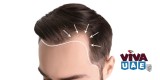 Best Hair Regrowth Clinic - 100% Assured Results 
