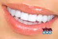 What is Dental Veneers Dubai?