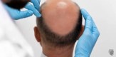 Affordable Hair Loss Treatment Price | AHS UAE