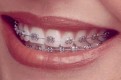 Metal braces dental treatment in Dubai UAE