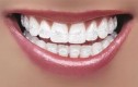 Ceramic braces dental treatment in Dubai UAE