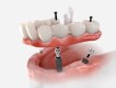 Dental implants treatment in Dubai UAE 
