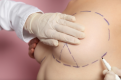 Breast lift surgery Dubai - Dr Adnan Tahir