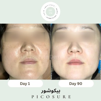Skin Care Treatment in Abu Dhabi | Picosure | بيكوشور في ابوظبي