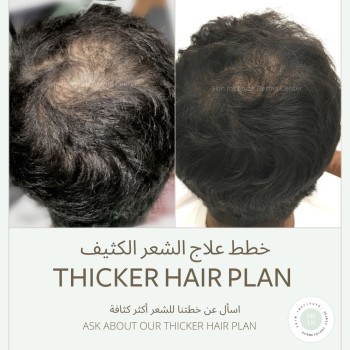 best hair specialist abudhabi | PRP treatment in abudhabi | PRP clinic