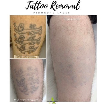 PicoSure treatment Abu Dhabi | بيكوشور | Picosure Tattoo Removal