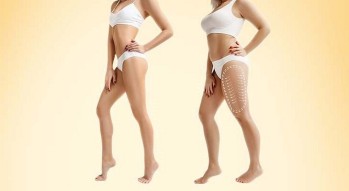 Best Liposuction Treatment in Dubai - Anshu Mishra