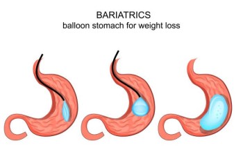 Achieve Safe  Weight Loss with Stomach Balloon Surgery in Dubai