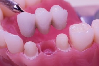 Best Dental Crown treatments clinic in Dubai UAE