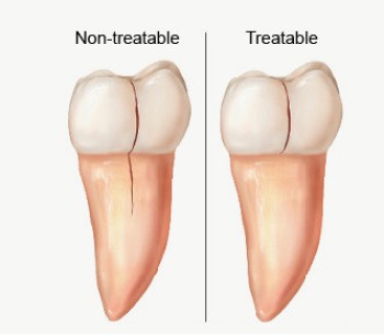 Best Cracked teeth treatments clinic in Dubai UAE