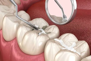 Best Dental sealant treatment clinic in Dubai UAE