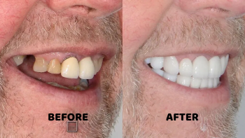 Effective solution on How to fix gap teeth in dubai