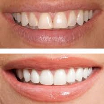 Best Dental Bonding treatment clinic in Dubai UAE