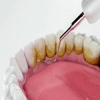 Best Dental scaling clinic in Dubai UAE