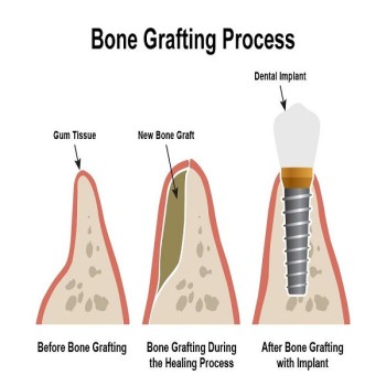 Best Bone grafting treatment in Dubai UAE