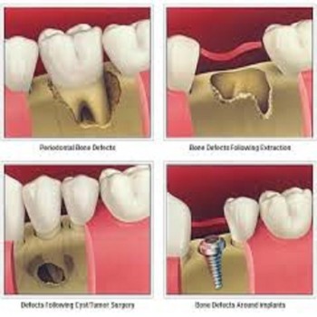 Best Periodontal bone grafts clinic in Dubai UAE