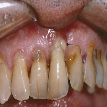 Best Gum disease treatment in Dubai UAE