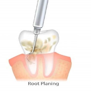 Best Root planning treatment in Dubai UAE