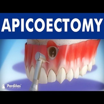 Best apicoectomy treatment in Dubai UAE