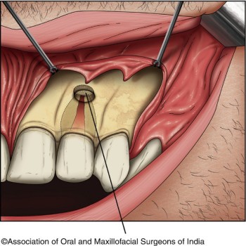 Best Endodontic surgery treatment in Dubai UAE