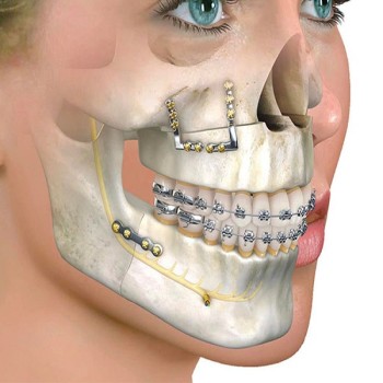 Best Jaw surgery treatment in Dubai UAE