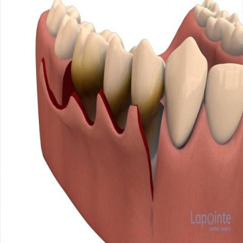 Best Periodontal surgery treatment in Dubai UAE