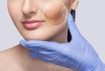 Acne Treatment in Jeddah